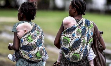 Goma: la menace du trafic d'organe des albinos persiste