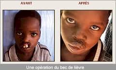 Ils  ont retrouvé leurs lèvres grâce à la Fondation Gerico